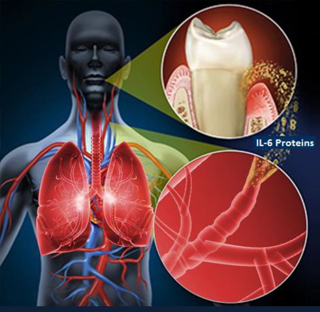 Respiratory Infections due to poor dental hygiene